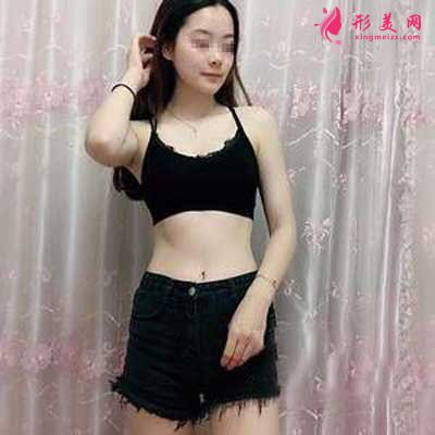 在鄭州悅美整形美容醫(yī)院做吸脂瘦腰腹+瘦大腿手術(shù)后1個(gè)月