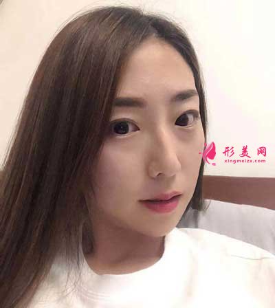 到和顏美帕找劉喆做的白瓷娃娃 術(shù)后15天效果很好