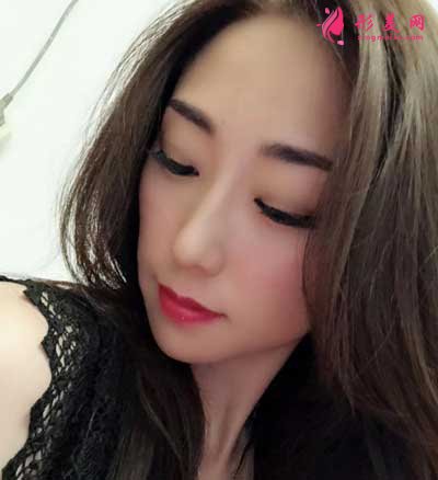 在和顏美帕找劉喆做的白瓷娃娃項目 術(shù)后30天效果圖分享