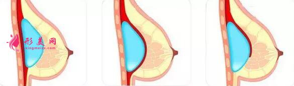 硅膠隆胸手術疼嗎？疼痛時間維持多久？