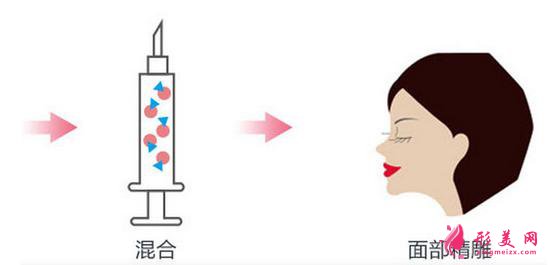 【術(shù)前科普】自體脂肪填充安全嗎？多久可以恢復