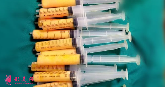 【術(shù)前科普】自體脂肪填充安全嗎？多久可以恢復