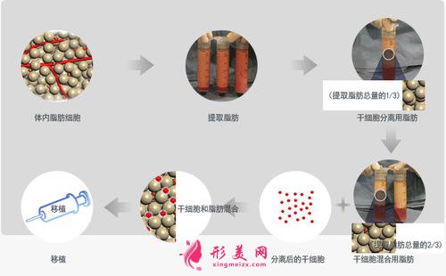 【術(shù)前科普】自體脂肪填充安全嗎？多久可以恢復