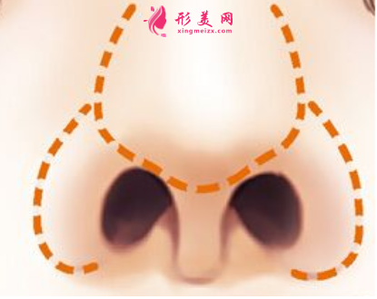 鼻翼縮小手術(shù)修復(fù)多少錢