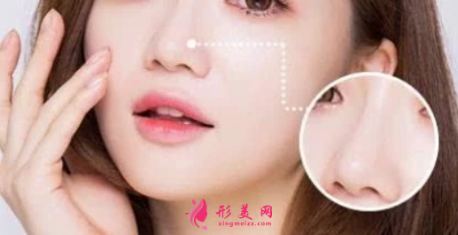 鼻翼縮小手術(shù)修復(fù)多少錢