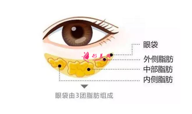 做去眼袋手術(shù)多少錢(qián)？有哪些方法？