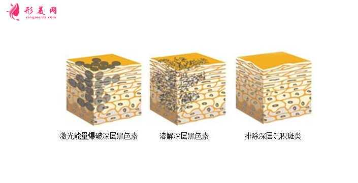 術(shù)前科普：激光祛斑多少錢一次？