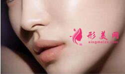 假體隆鼻多久鼻子不發(fā)紅