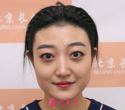 北京畫美瘦臉案例