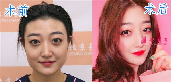 北京畫美瘦臉案例