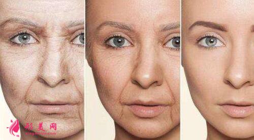 自體脂肪可以填充法令紋嗎?術(shù)后有什么注意事項(xiàng)嗎