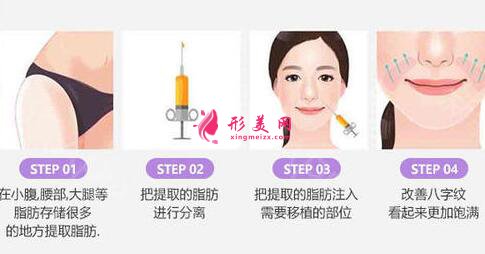 自體脂肪可以填充法令紋嗎?術(shù)后有什么注意事項(xiàng)嗎