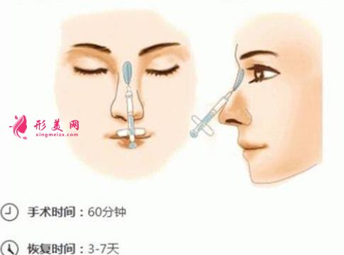 做自體脂肪隆鼻可能會(huì)變寬嗎?危害什么