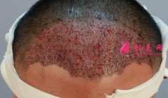 發(fā)際線種植手術(shù)的優(yōu)勢是什么？術(shù)前準(zhǔn)備都有哪