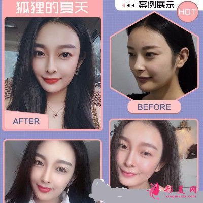 曹平進(jìn)行面部線條雕刻和埋線促銷的示例