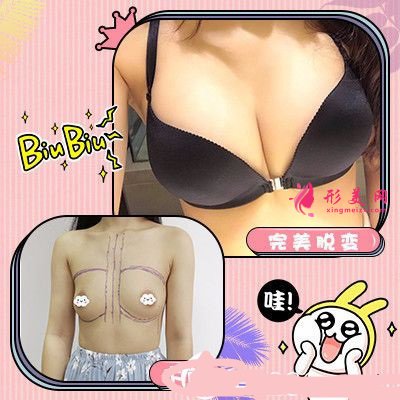 高風(fēng)假體隆胸案例