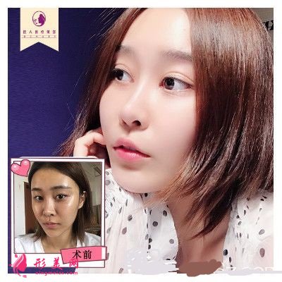 王高鳳做的雙眼皮隆鼻手術(shù)