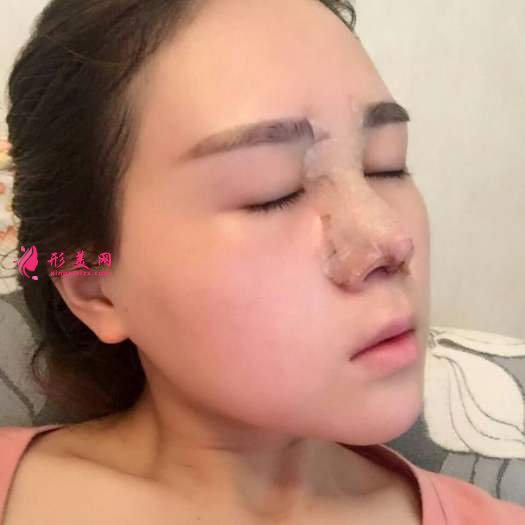 做自體肋軟骨和膨體綜合隆鼻后感受 做自體肋軟骨和膨體綜合隆鼻后感受