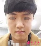 北京八大處整形醫(yī)院削骨怎么樣？手術(shù)后恢復(fù)男生也能錐子臉