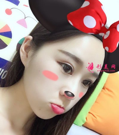 北京八大處楊明勇做雙眼皮修復手術后