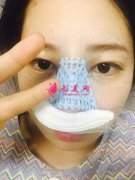 長沙美萊整形醫(yī)院潘衛(wèi)峰院長做的隆鼻效果公開，手術(shù)日記分享