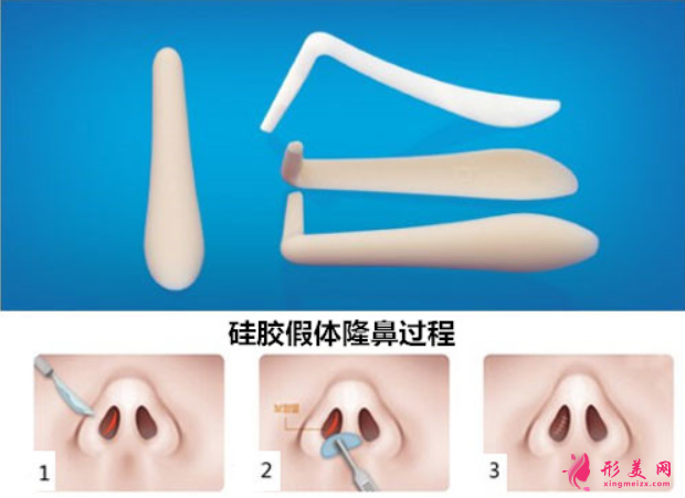 假體隆鼻術后還要更換嗎