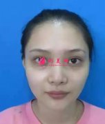 深圳北大醫(yī)院整形外科去眼袋怎么樣？