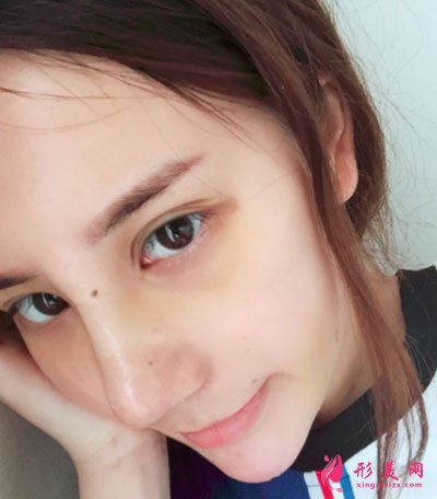 寧波薇琳醫(yī)療美容醫(yī)院肋軟骨隆鼻案例