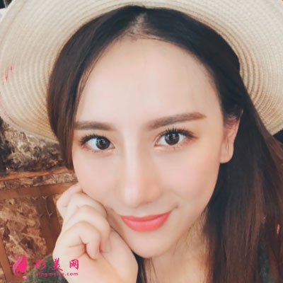 寧波薇琳醫(yī)療美容醫(yī)院肋軟骨隆鼻案例