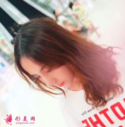 寧波薇琳醫(yī)療美容醫(yī)院肋軟骨隆鼻案例