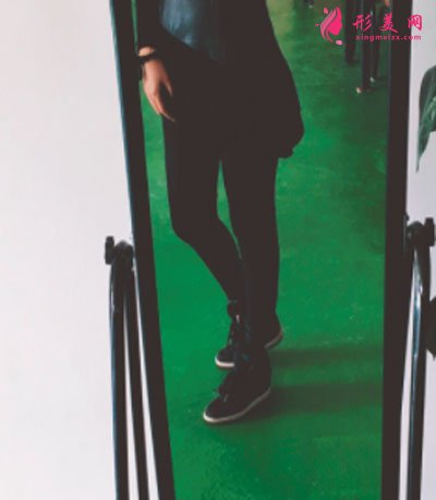 天津維美醫(yī)療美容醫(yī)院做的吸脂瘦大腿