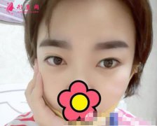 湖南省人民醫(yī)院整形科做雙眼皮咋樣?術(shù)后經(jīng)驗(yàn)效果一覽