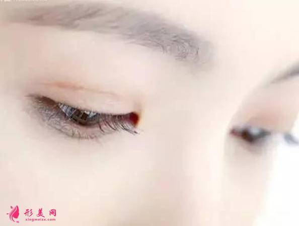 雙眼皮術(shù)后要做哪些護(hù)理工作