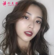 上海第九人民醫(yī)院整形科面部脂肪填充效果咋樣?實拍圖分享