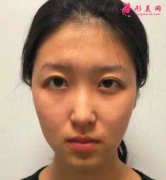 寧波靜港整形自體脂肪面部填充真人案例分享！術(shù)后兩個月效果很好