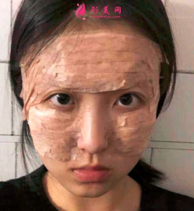 寧波靜港整形自體脂肪面部填充案例