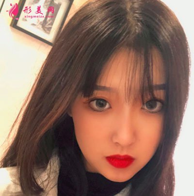 寧波靜港整形自體脂肪面部填充案例