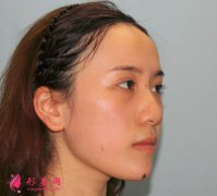 寧波薇琳醫(yī)療美容醫(yī)院肋軟骨隆鼻怎么樣？術(shù)后兩個月效果很滿意