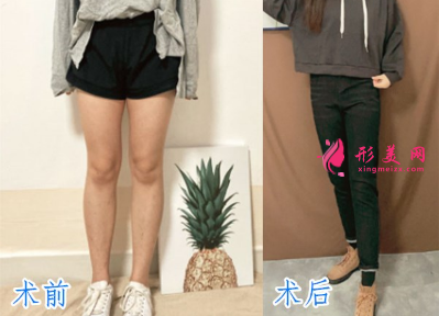 寧波靜港整形美容祝海新案例