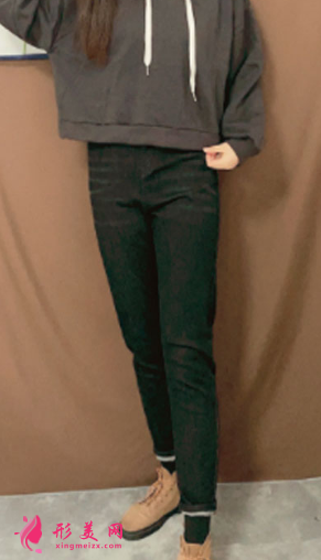 寧波靜港整形美容祝海新案例