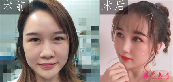 武漢韓辰醫(yī)療美容鼻部多項(xiàng)案例 