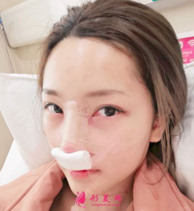 寧波珈禾肋軟骨隆鼻案例