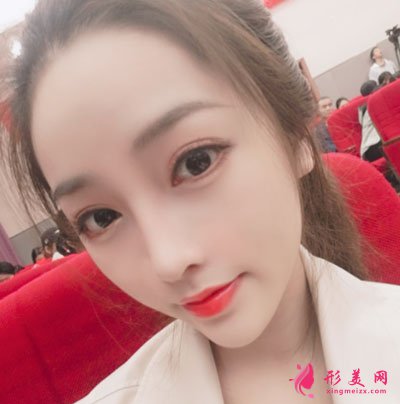 寧波珈禾肋軟骨隆鼻案例