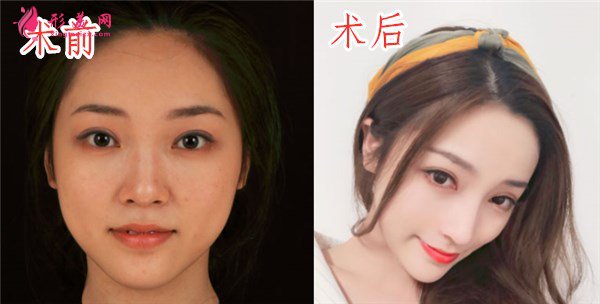 寧波珈禾肋軟骨隆鼻案例