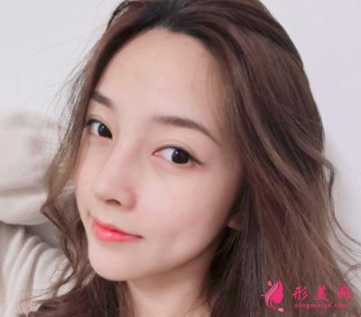 寧波珈禾肋軟骨隆鼻案例