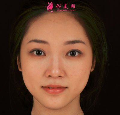 寧波珈禾肋軟骨隆鼻案例