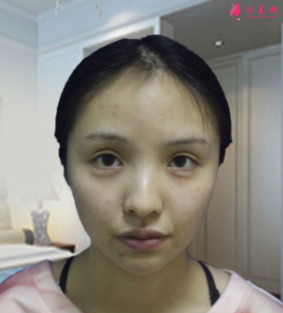 成都醫(yī)大整形美容醫(yī)院的鼻綜合整形案例