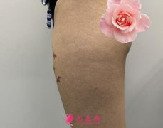 上海九院整形科大腿吸脂怎么樣?真人案例效果對(duì)比圖看技術(shù)