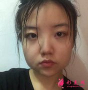 廣州廣大下頜角整形案例及價(jià)格表明細(xì)一覽！