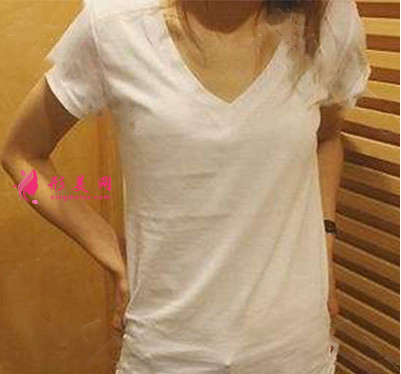 北京葉子整形醫(yī)院楊峰假體隆胸